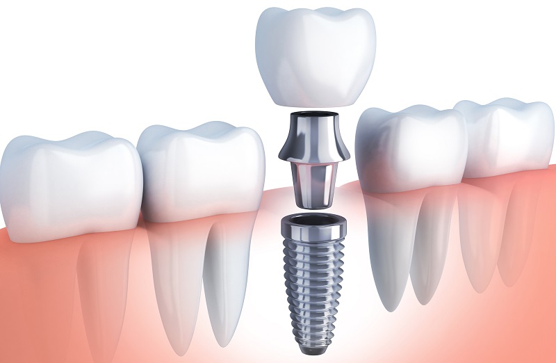 ایمپلنت دندان