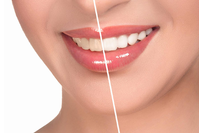 کامپوزیت دندان